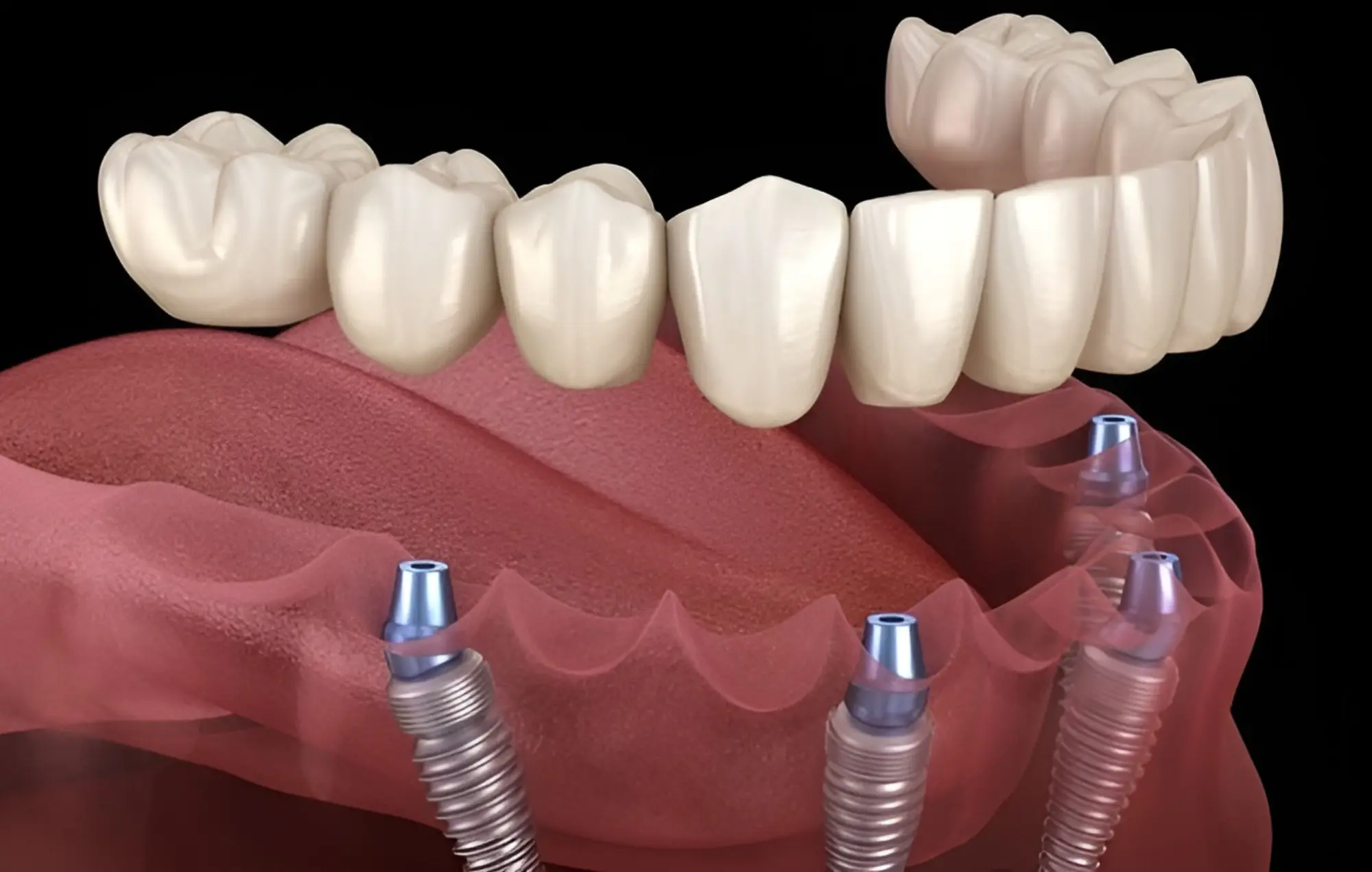 Implant Surgery